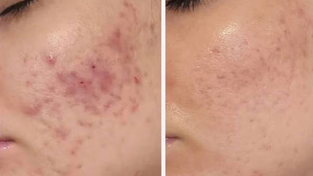 ‘Best product I’ve ever owned’ is £30 gel that ‘transformed my spot scarred skin’