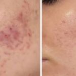 ‘Best product I’ve ever owned’ is £30 gel that ‘transformed my spot scarred skin’