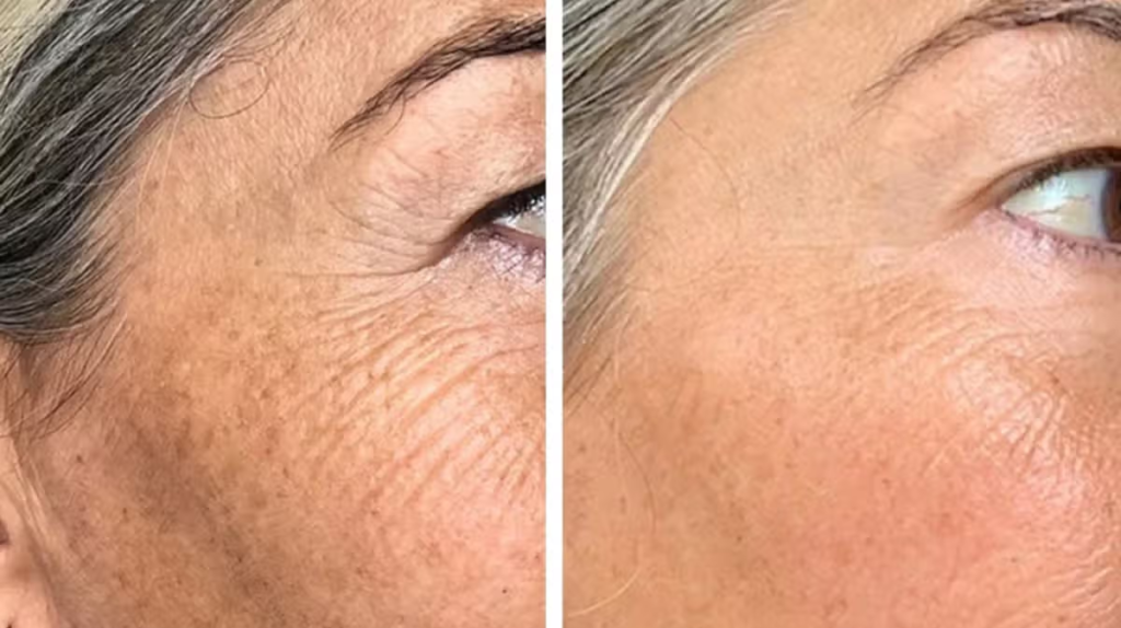 Woman says £240 off face mask makes big ‘difference to wrinkles in 2 weeks of use’