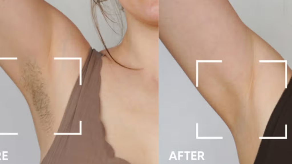 ‘Best hair removal method I’ve tried’ with ‘no pain’ now with £170 off