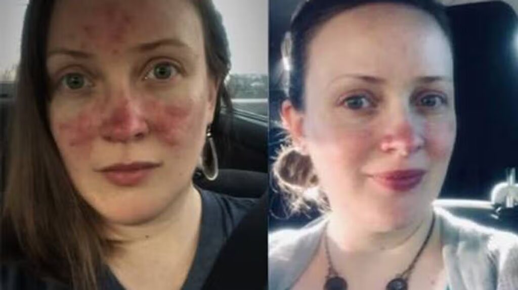 Ex-model with ‘furious’ rosacea says £15 face cream ‘changed my life’
