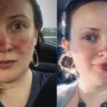Ex-model with ‘furious’ rosacea says £15 face cream ‘changed my life’