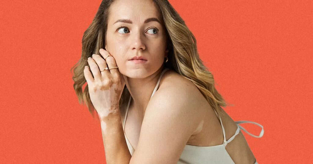 The Confidence I Found Through Living With Vitiligo