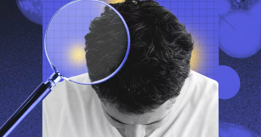 Is It Really Dandruff? The Science Behind Seborrheic Dermatitis