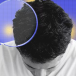 Is It Really Dandruff? The Science Behind Seborrheic Dermatitis