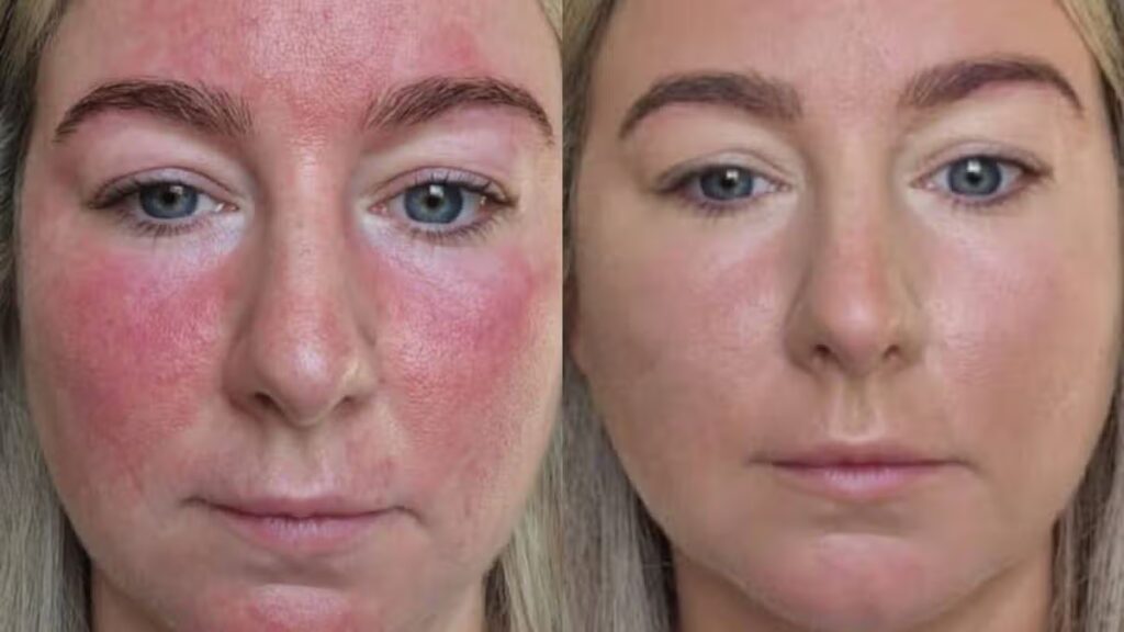 ‘I can’t thank you enough, my redness has disappeared’ as cream slashed to £25