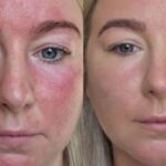‘I can’t thank you enough, my redness has disappeared’ as cream slashed to £25