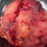 8-Hour Surgery Removes 2.5 Kg Kidney Tumour In Indore